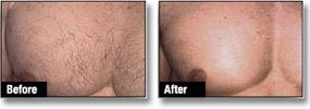 Before and after comparison of man's chest hair after laser hair reduction treatment
