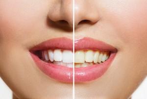 Woman Teeth Before and After Whitening. Over white background. H