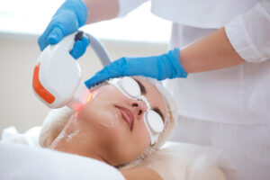 Close-up of a woman undergoing laser treatment for acne at a modern clinic, with advanced laser technology targeting acne for clearer, healthier skin.