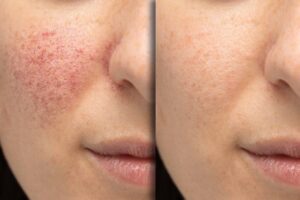 Before and after laser treatment for rosacea › Hellenic Laser Spa Before and after photo of a woman showcasing successful acne treatment for mature skin, with smoother and clearer complexion.