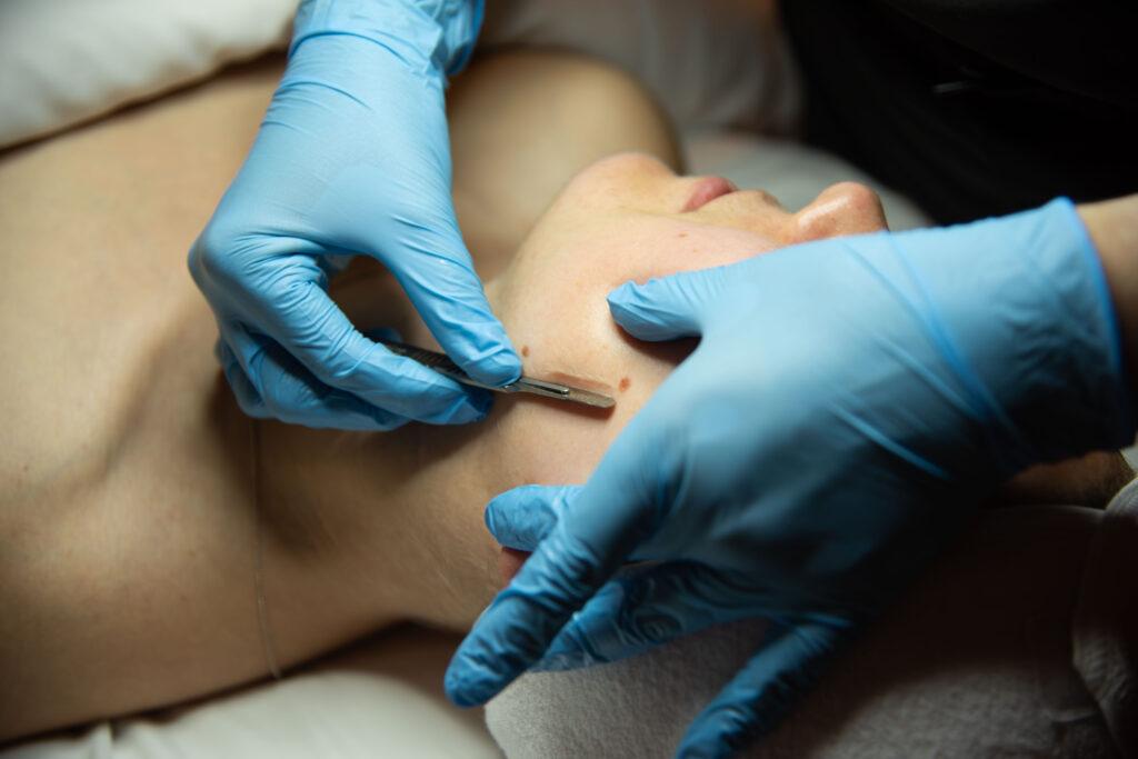 Woman getting dermaplane facial at spa › Hellenic Laser Spa Dermaplane treatment being performed on a woman's face to remove dead skin cells and peach fuzz, improving overall skin texture and radiance.