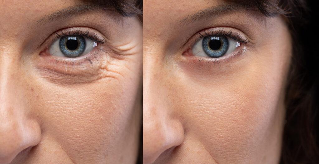 Woman’s eyes before and after anti-aging injectables for face wrinkles, showing reduced crow’s feet and smoother skin texture.