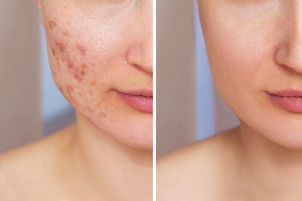 Cropped shot of a young womans face before and after acne treatment Pimples red scars on the girls cheeks Problem skin care and beauty concept Dermatology cosmetology › Hellenic Laser Spa Before and after results of a woman’s face showing improvements from Acne scar treatments for deep scars and uneven skin tone