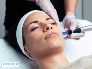 Microneedling procedure being performed on facial skin using a derma roller device to stimulate collagen and improve skin texture.