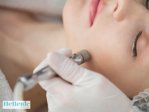 Woman undergoing microdermabrasion as part of professional acne treatment for hormonal acne